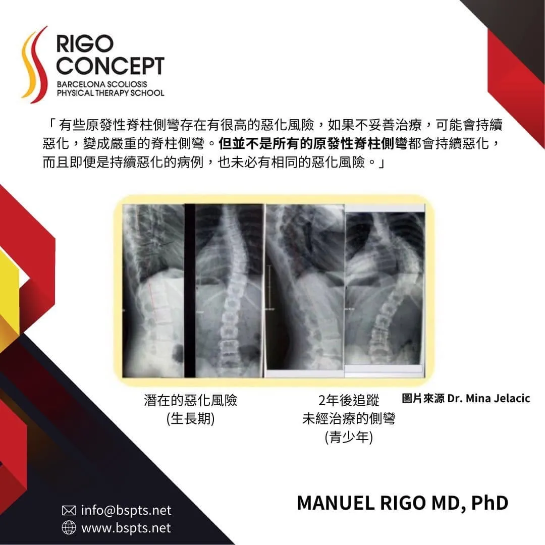 圖卡：Manuel Rigo 醫師談原發性脊柱側彎的惡化風險——並非所有側彎都會持續惡化；並列生長期 X 光與 2 年後未經治療追蹤的 X 光（圖片來源 Dr. Mina Jelacic）