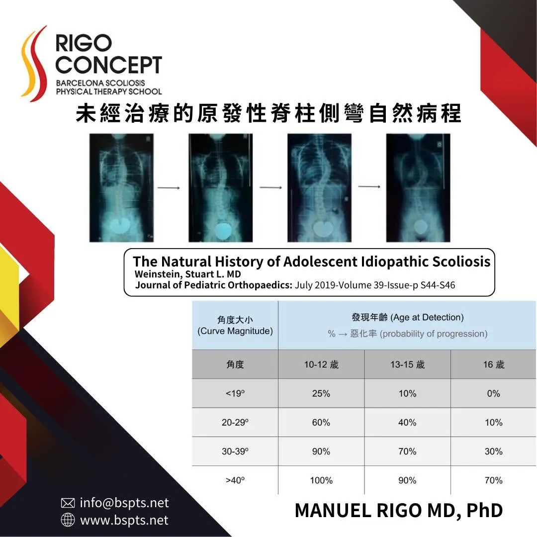 圖卡：未經治療的原發性脊柱側彎自然病程——四張全脊椎 X 光顯示側彎逐步加大，附 Weinstein（2019）依側彎角度與發現年齡（10–12、13–15、16 歲）列出的惡化機率表