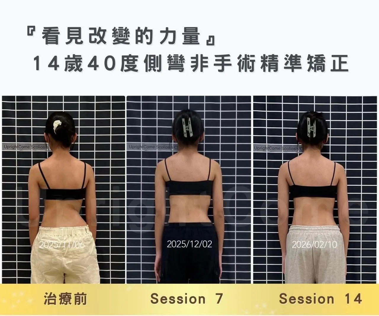 個案紀錄圖卡「看見改變的力量」:14 歲 40 度側彎非手術矯正,治療前、第 7 次與第 14 次課程的背面體態比較(挺立康紀錄,個案同意使用)