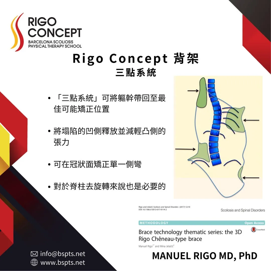圖卡：Rigo Concept 背架三點系統——可將軀幹帶回最佳可能矯正位置、釋放塌陷的凹側並減輕凸側張力、在冠狀面矯正單一側彎、對脊柱去旋轉也是必要的；附背架施力點箭頭示意圖