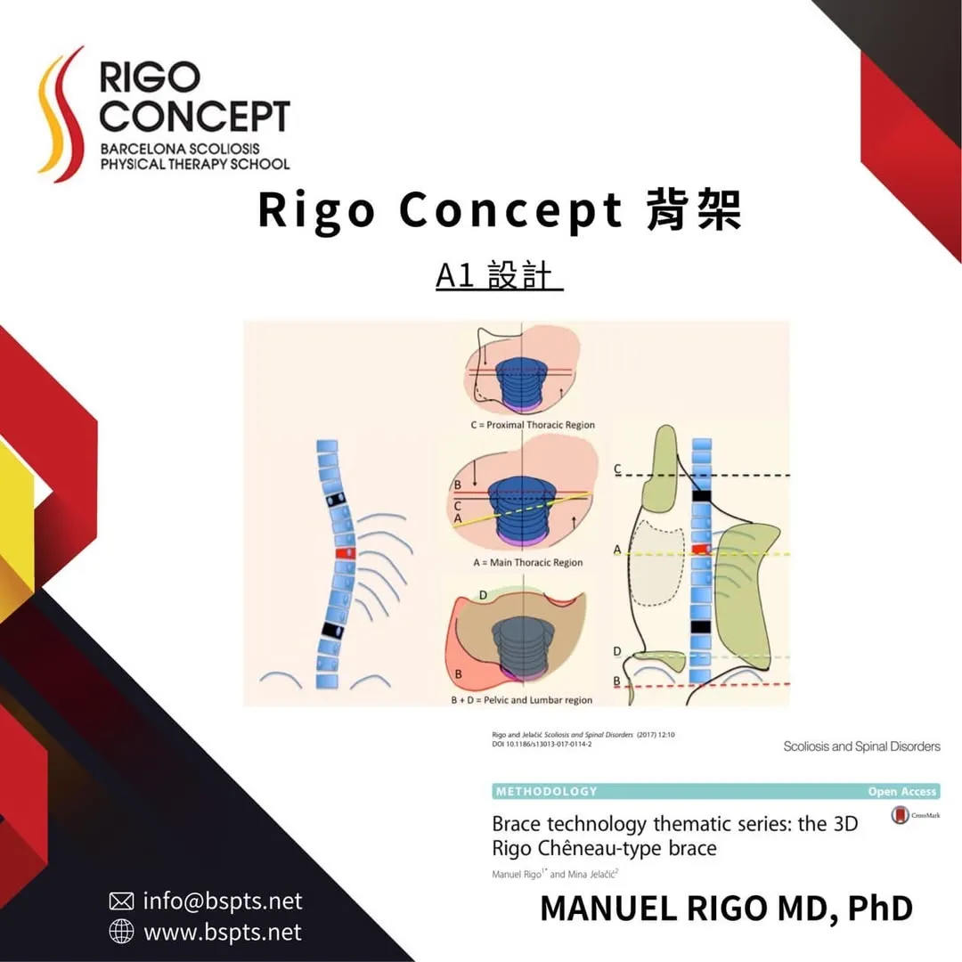 圖卡：Rigo Concept 背架 A1 設計——脊柱側彎示意圖，搭配近端胸椎區（C）、主胸椎區（A）、骨盆與腰椎區（B + D）的橫切面施力示意與背架輪廓圖