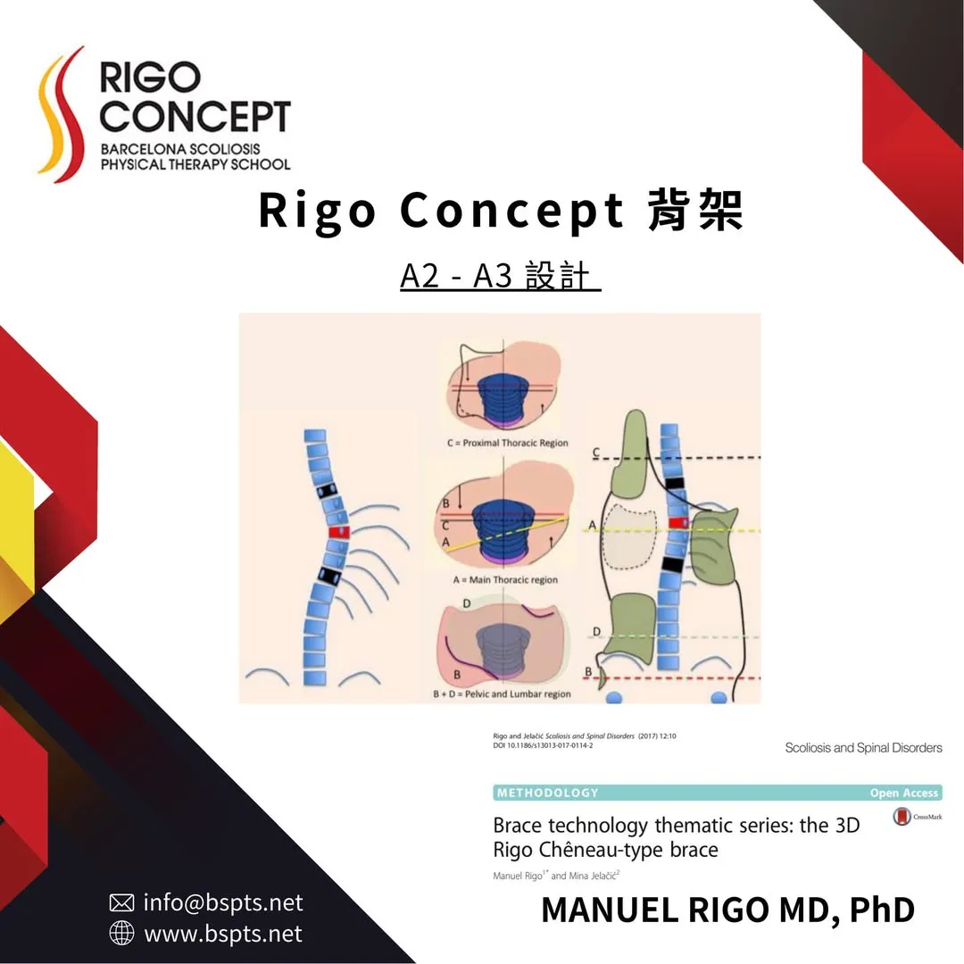 圖卡：Rigo Concept 背架 A2–A3 設計——脊柱側彎示意圖，搭配近端胸椎區（C）、主胸椎區（A）、骨盆與腰椎區（B + D）的橫切面施力示意與背架輪廓圖