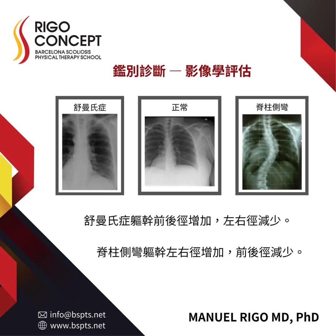 圖卡：鑑別診斷——影像學評估。並列舒曼氏症、正常、脊柱側彎三張胸部 X 光；說明舒曼氏症軀幹前後徑增加、左右徑減少，脊柱側彎則左右徑增加、前後徑減少