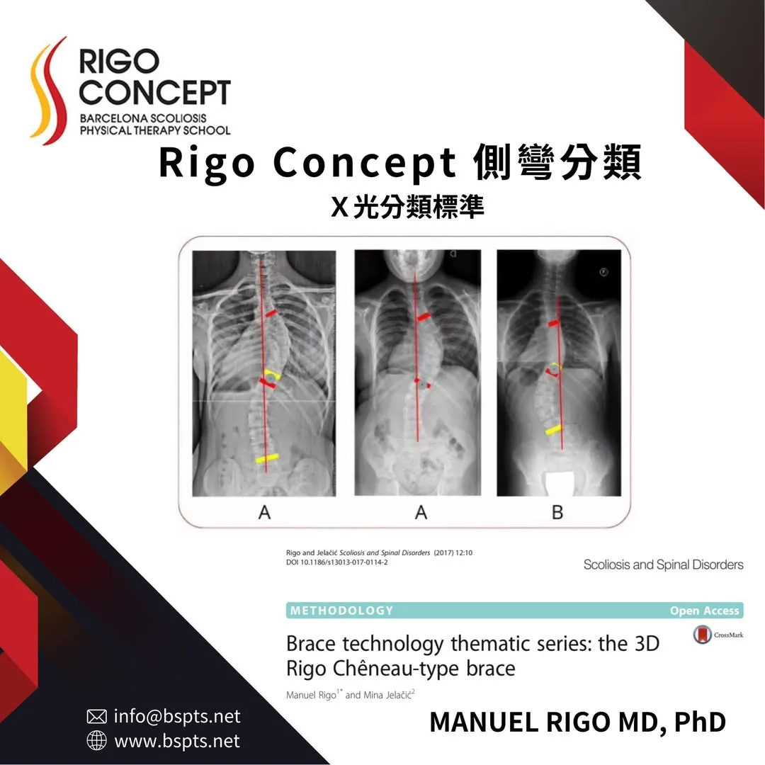 圖卡：Rigo Concept 側彎分類的 X 光分類標準，三張標註中垂線與分類記號的全脊柱 X 光範例，分別標示類型 A、A、B；出自 Rigo 與 Jelačić 2017 年論文