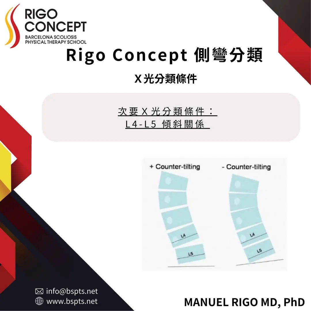 圖卡：Rigo Concept 側彎分類的次要 X 光分類條件——L4-L5 傾斜關係，以腰椎示意圖對照「+ Counter-tilting」與「- Counter-tilting」兩種情形