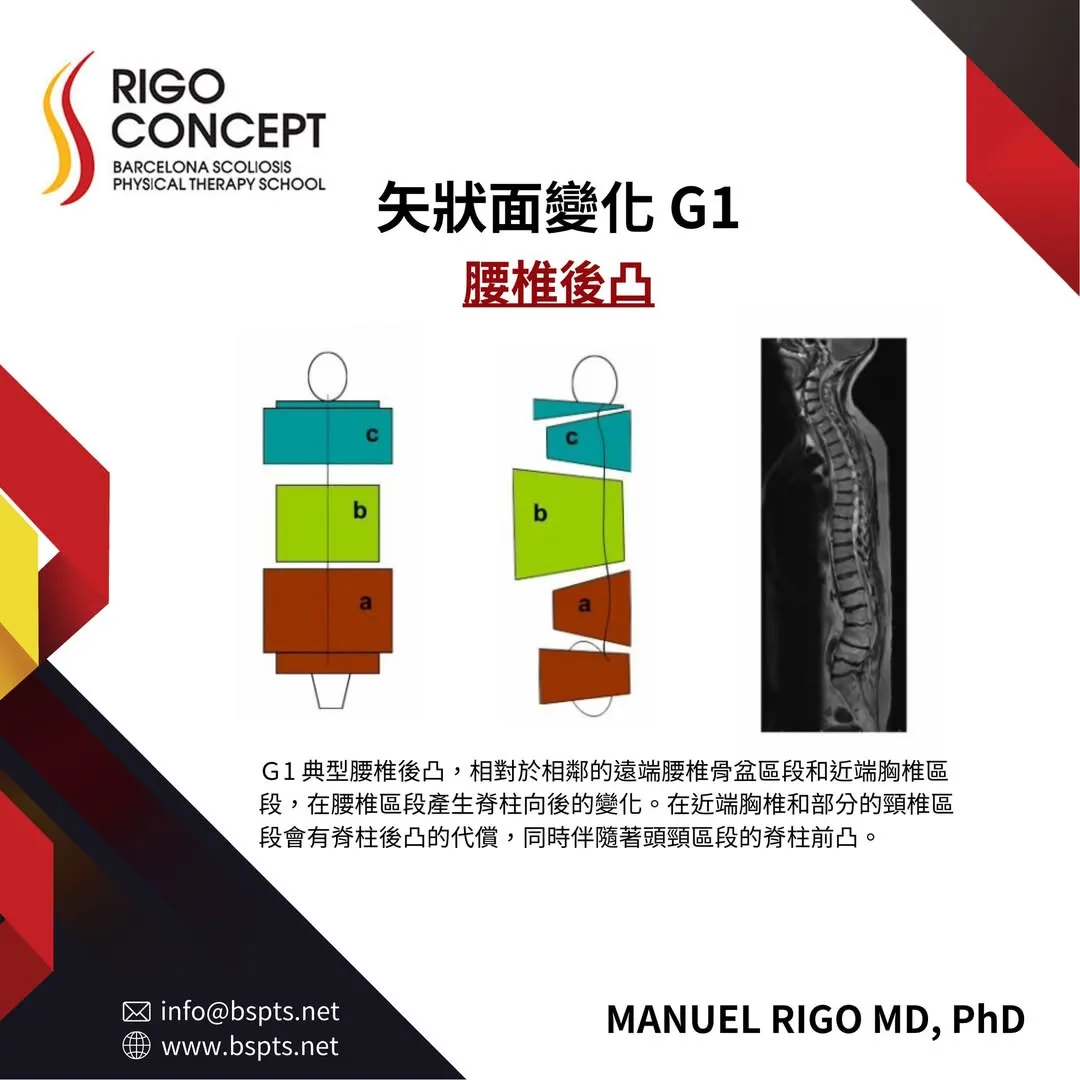圖卡：矢狀面變化 G1——腰椎後凸。以 a、b、c 三個區塊示意圖與一張脊柱側面影像，說明腰椎區段向後變化，近端胸椎與部分頸椎出現後凸代償，並伴隨頭頸區段前凸