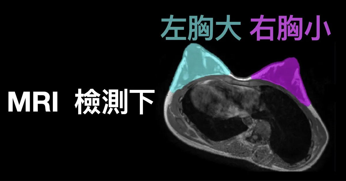 胸部 MRI 橫切面影像，以青綠色與紫色分別標示兩側乳房組織，標註「MRI 檢測下：左胸大、右胸小」