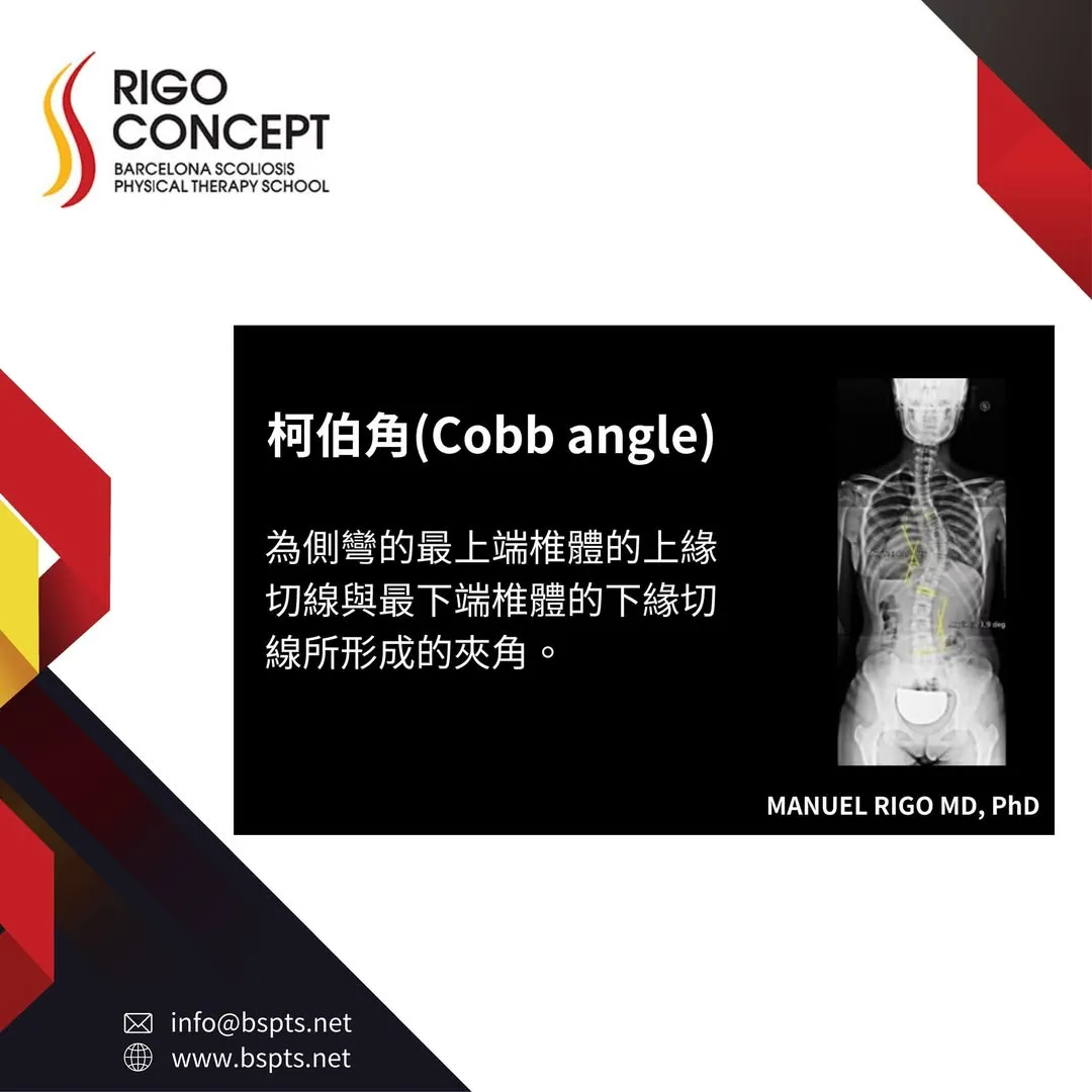 圖卡：柯柏角（Cobb angle）——側彎最上端椎體上緣切線與最下端椎體下緣切線所形成的夾角，旁附標有量測線的全脊椎正面 X 光片