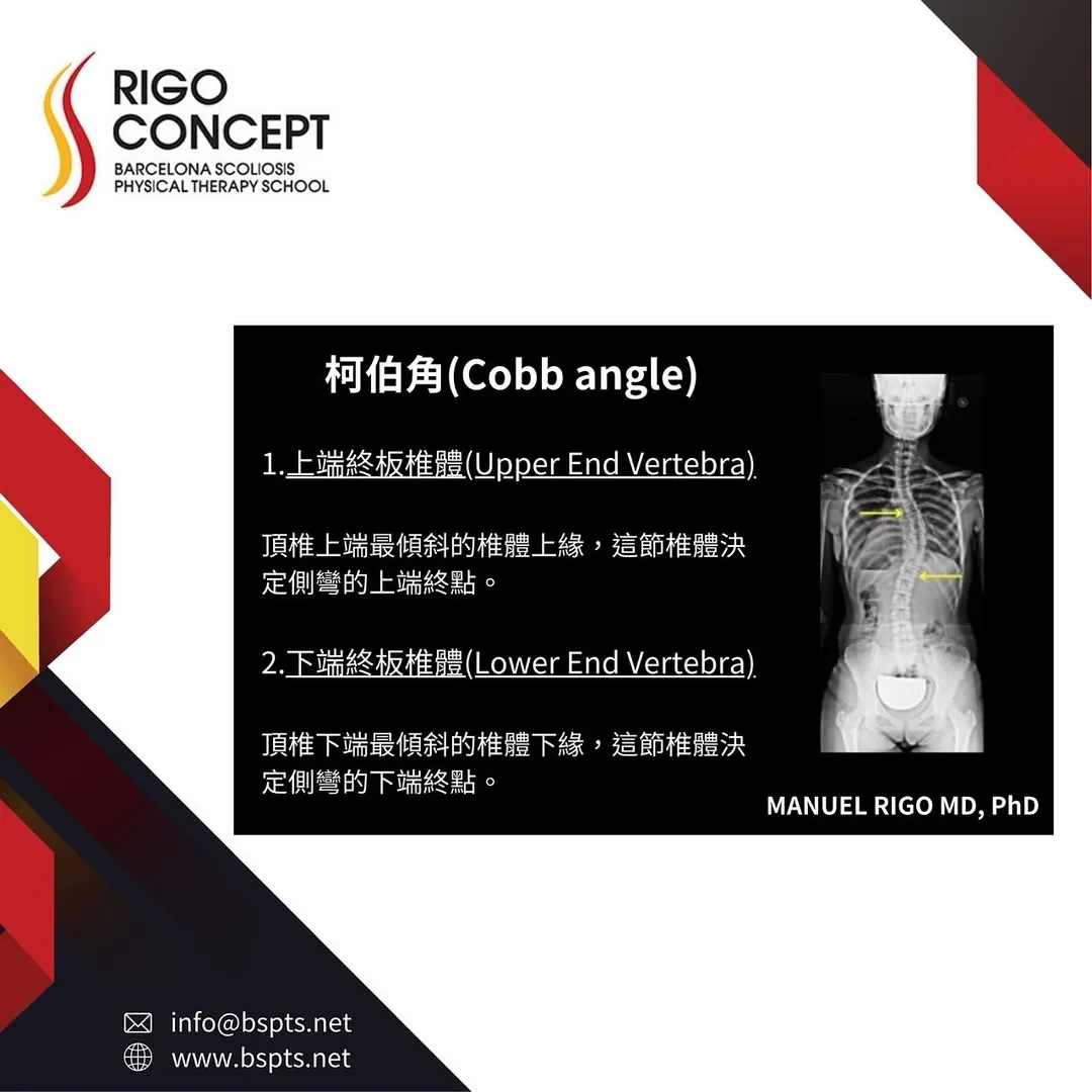 圖卡：柯柏角（Cobb angle）的端椎——上端終板椎體（Upper End Vertebra）為頂椎上方最傾斜的椎體，決定側彎上端終點；下端終板椎體（Lower End Vertebra）為頂椎下方最傾斜的椎體，決定下端終點；X 光片以箭頭標示