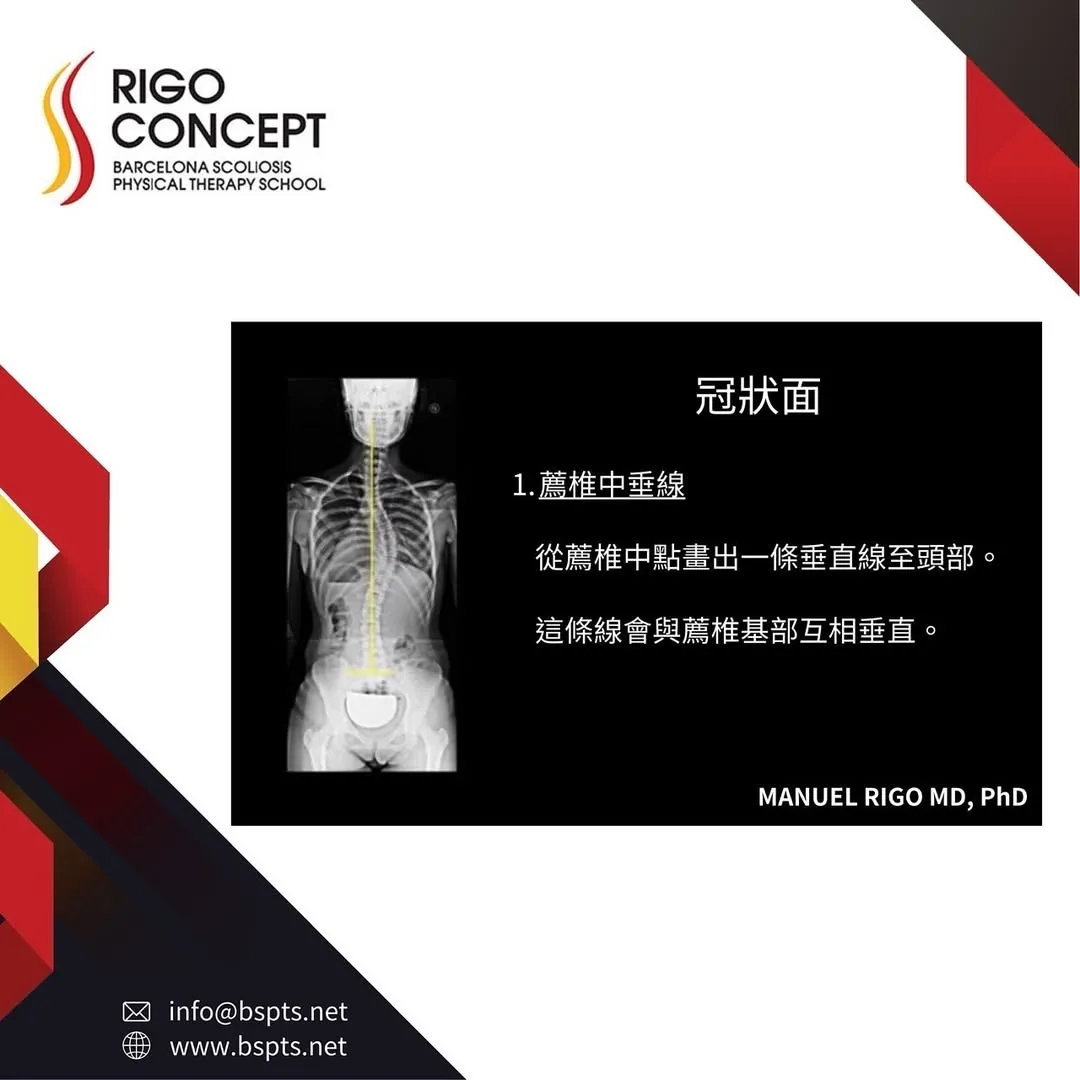 圖卡：冠狀面——1. 薦椎中垂線：從薦椎中點畫一條垂直線至頭部，與薦椎基部互相垂直；旁附畫有黃色中垂線的全脊椎正面 X 光片