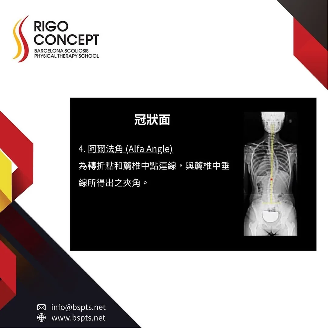 圖卡：冠狀面——4. 阿爾法角（Alfa Angle）：轉折點與薦椎中點的連線，與薦椎中垂線所形成的夾角；旁附標有中垂線與轉折點的全脊椎正面 X 光片