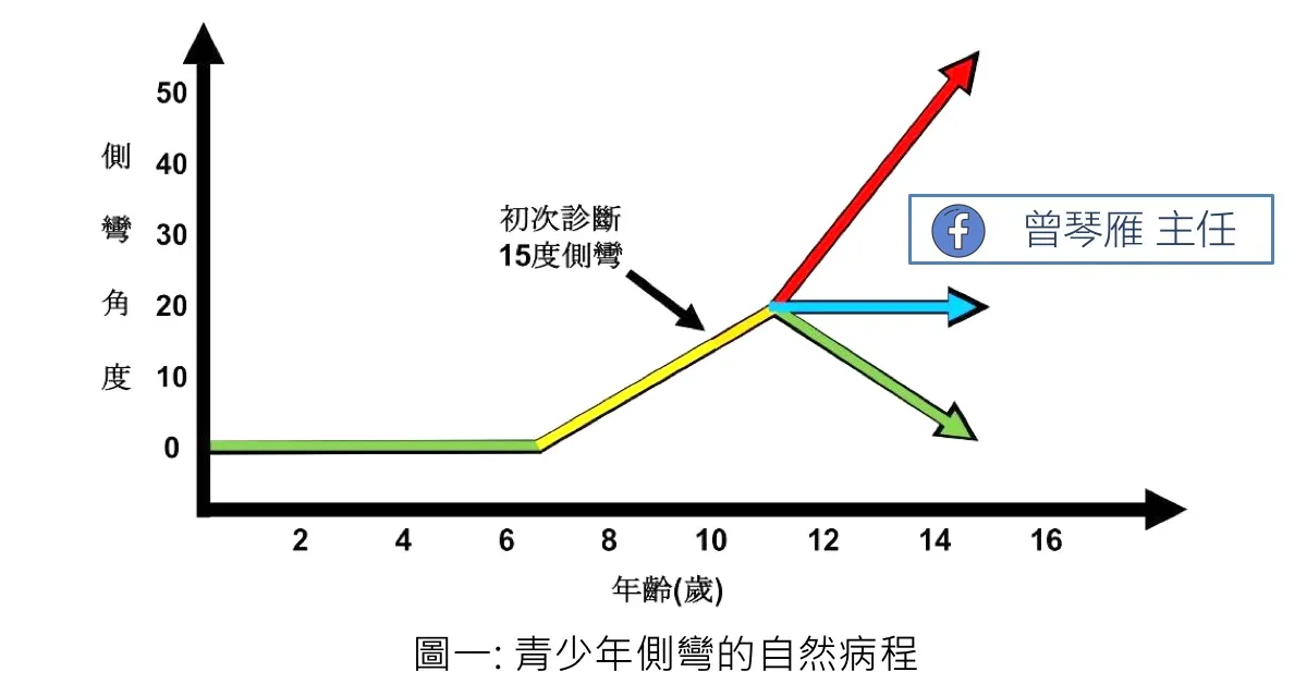 圖一：青少年側彎的自然病程——縱軸為側彎角度（0–50度），橫軸為年齡（歲）；約7歲後角度開始上升，箭頭標示「初次診斷 15度側彎」，之後分岔為上升、持平、下降三種走向
