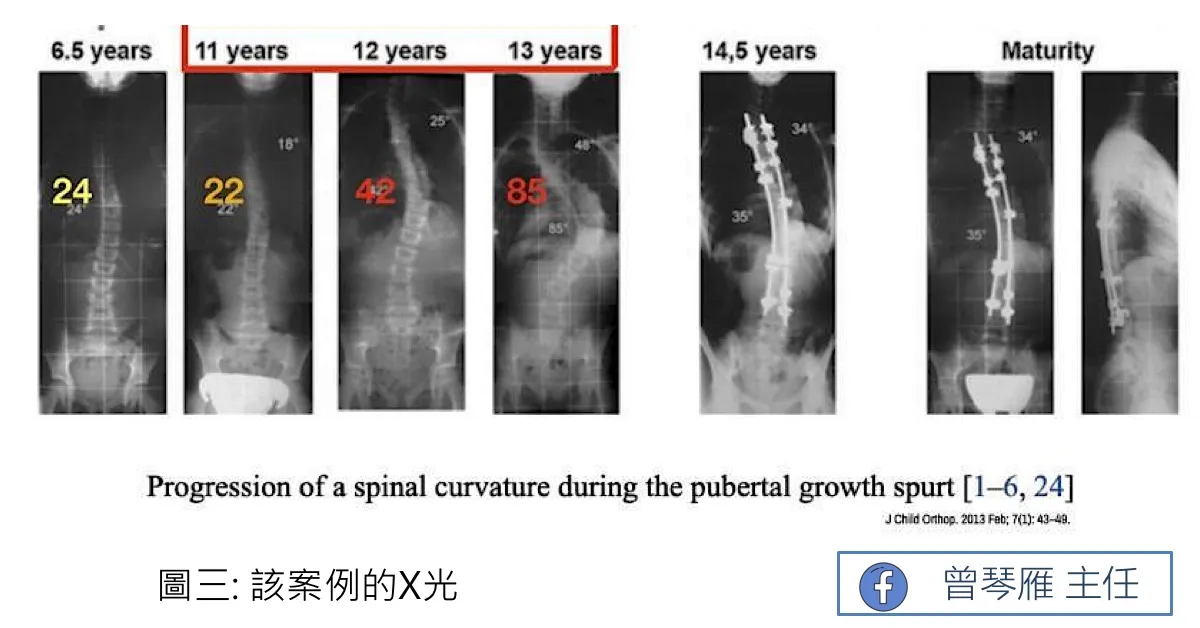 X光序列：同一個案在6.5、11、12、13歲的側彎角度分別為24°、22°、42°、85°，14.5歲與成熟期影像可見脊椎內固定器械、角度約35°；標題「圖三：該案例的X光」，出處J Child Orthop 2013